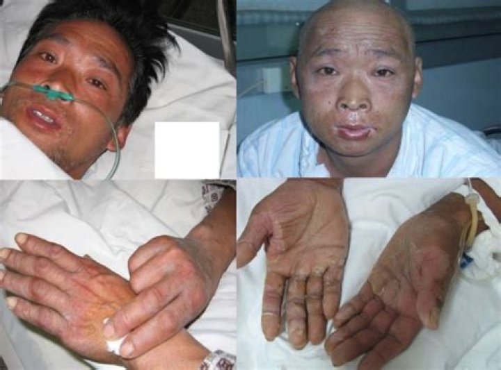 Hisashi Ouchi: The Tragic Story of a Nuclear Accident Victim